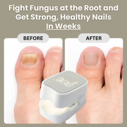 TRENDFOL™ - Nail Fungus Laser Device