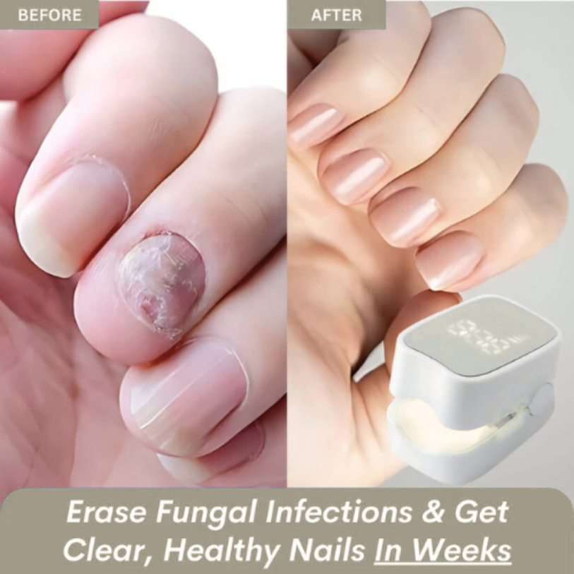 TRENDFOL™ - Nail Fungus Laser Device