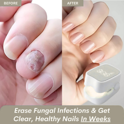TRENDFOL™ - Nail Fungus Laser Device