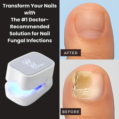TRENDFOL™ - Nail Fungus Laser Device